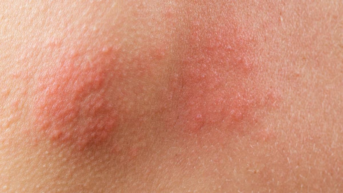 ερπης ζωστηρας