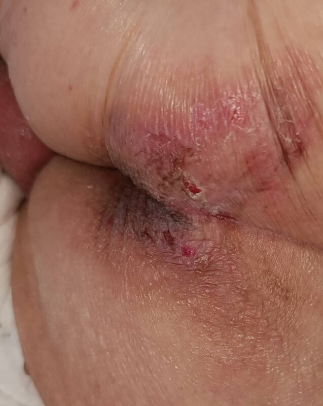 Στάδιο 1 - Κατάκλιση 1ου βαθμου