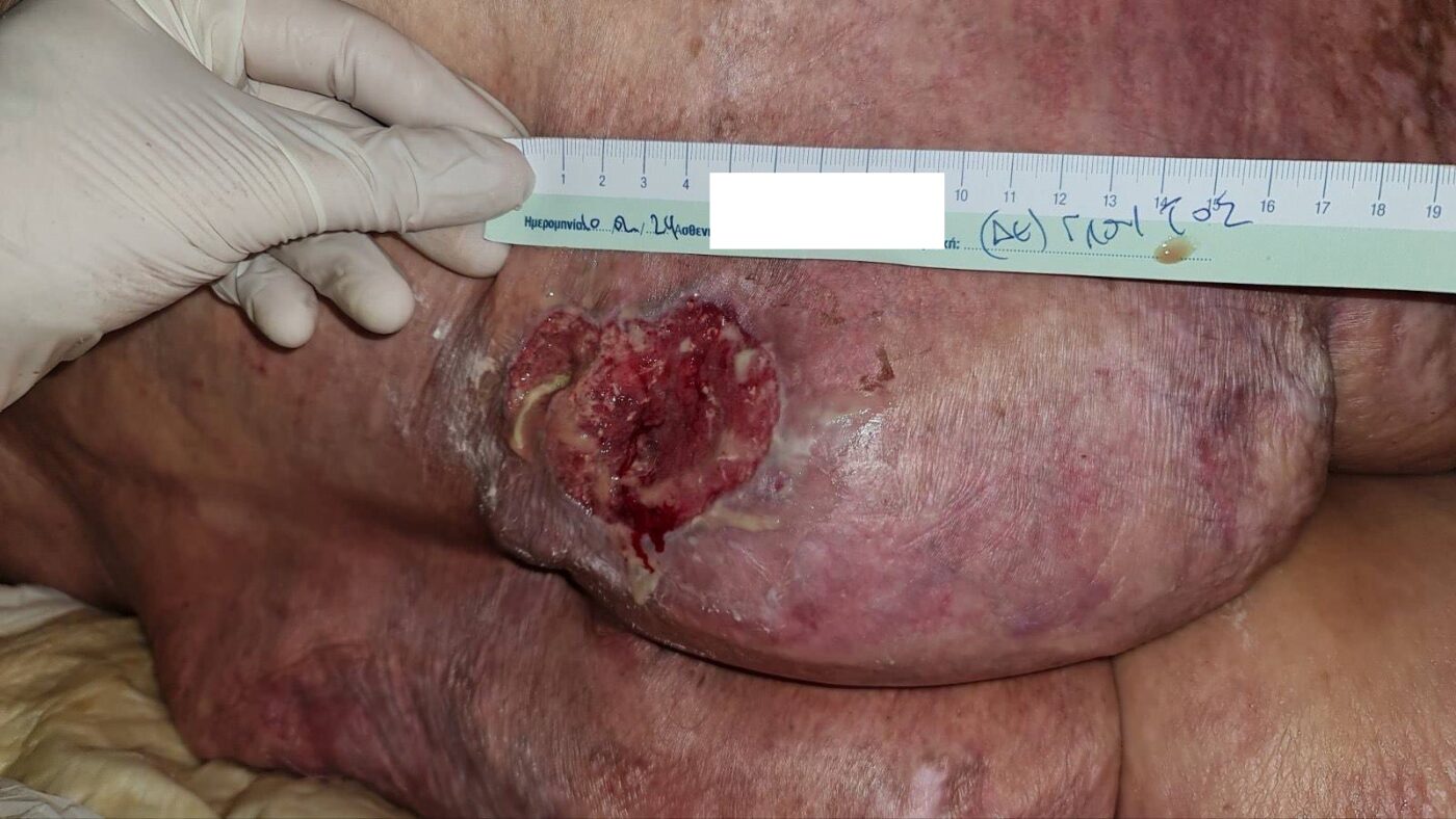 Στάδιο 2 - Κατάκλιση 2ου βαθμου