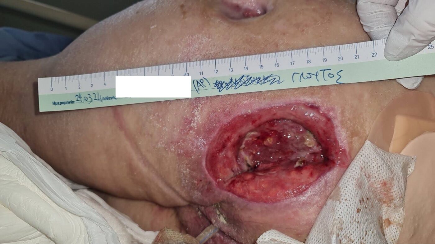 Στάδιο 3 - Κατάκλιση 3ου βαθμου