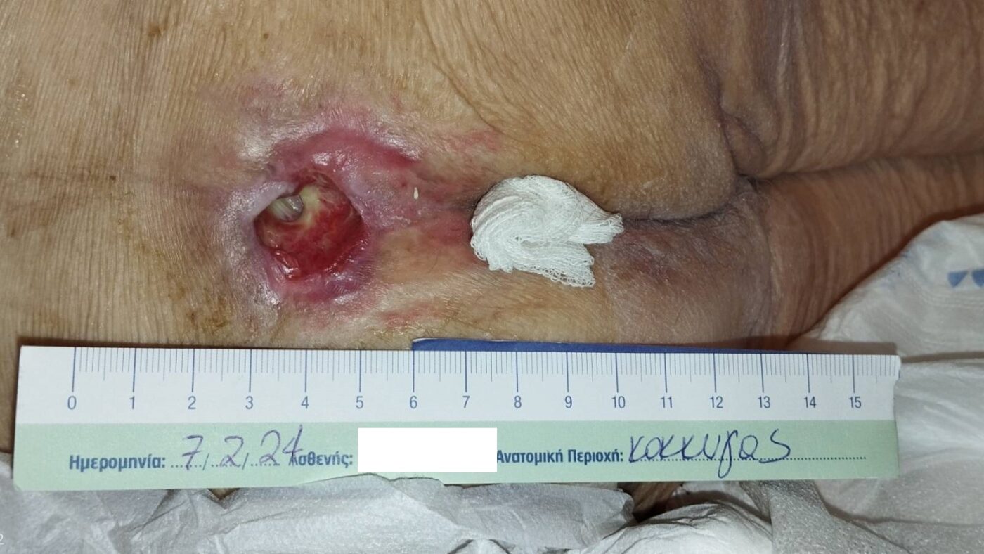 Στάδιο 4 - Κατάκλιση 4ου βαθμου