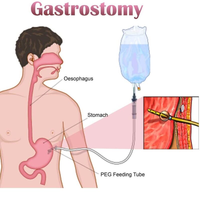 γαστροστομια-doctorhomecare