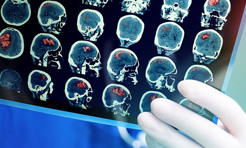Ισχαιμικό Εγκεφαλικό Επεισόδιο: Αίτια, Συμπτώματα και Θεραπεία