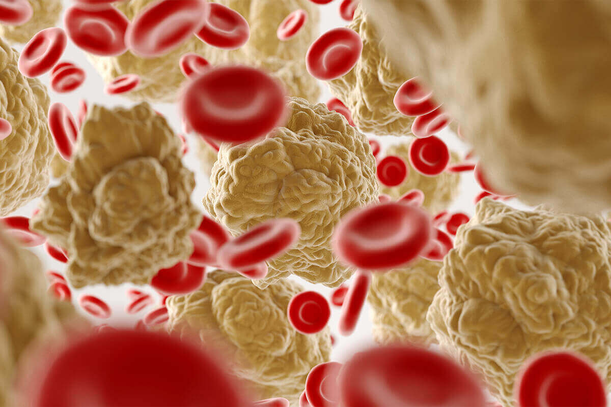 καρκίνοσ-του-προστατη-σταδια-doctorhomecare