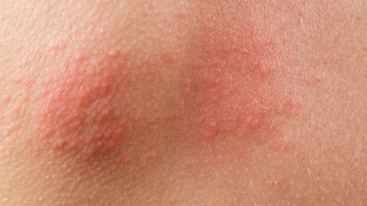 Έρπης Ζωστήρας: Συμπτώματα & Θεραπεία - Doctor Home Care