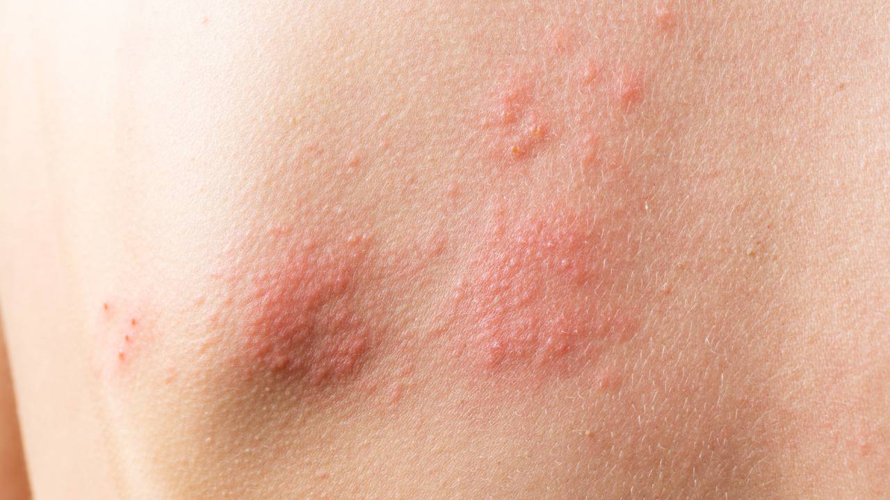 ερπης ζωστηρας μεταδοση