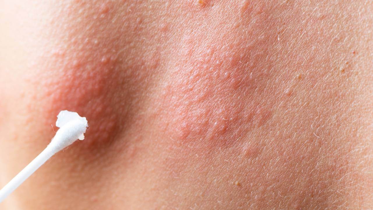 θεραπεια του ερπη ζωστηρα