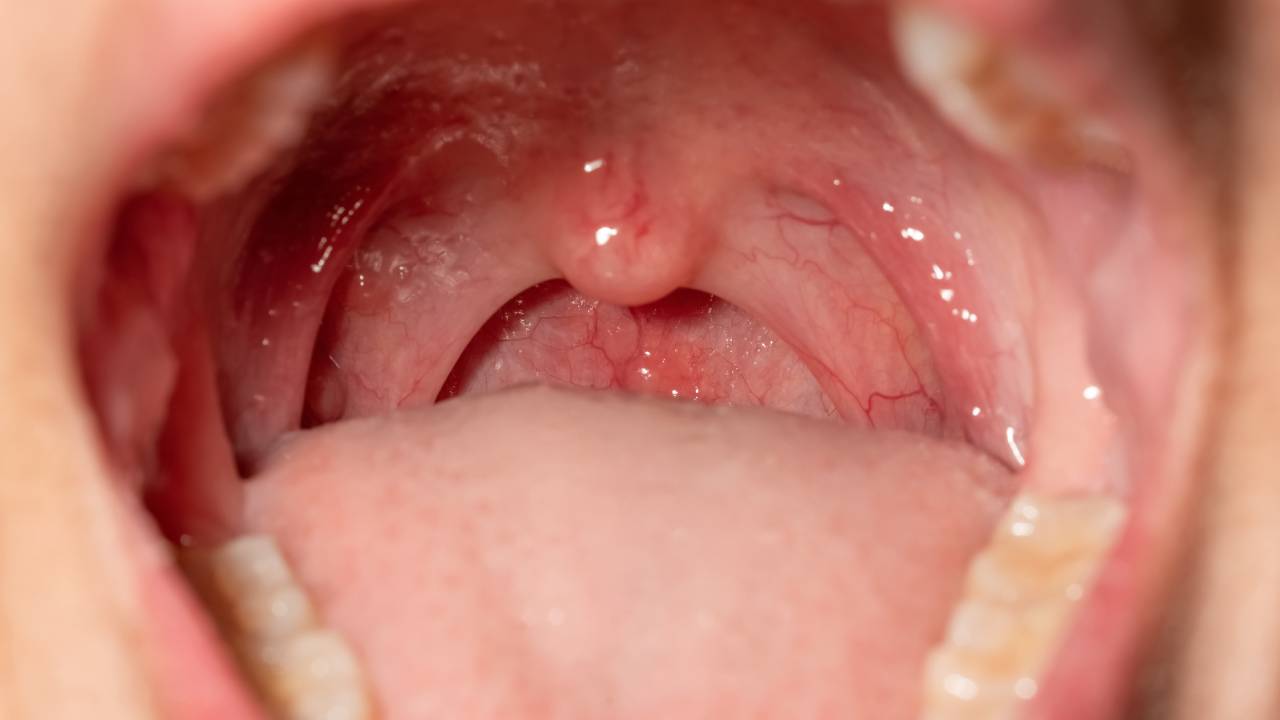 Που οφείλεται η αμυγδαλίτιδα;