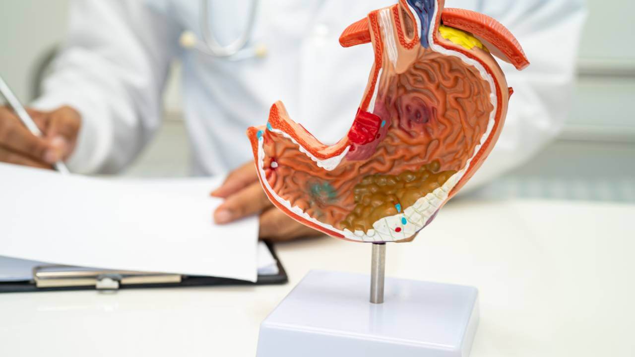 Έλκος στομάχου: Αιτίες, Συμπτώματα και Θεραπεία