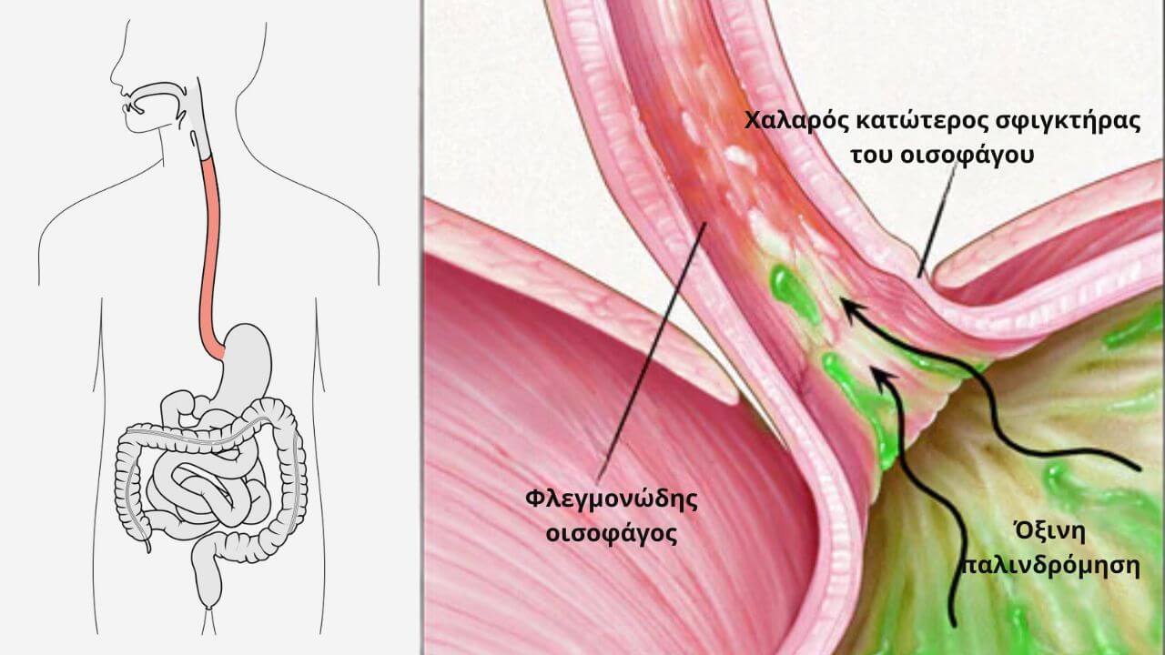 Γαστροοισοφαγική Παλινδρόμηση Συμπτώματα