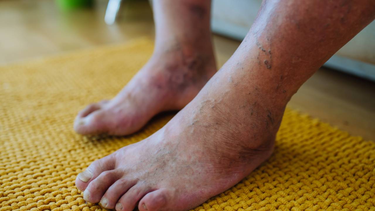 Διαβητικό Πόδι: Συμπτώματα και Θεραπεία - Doctor Home Care