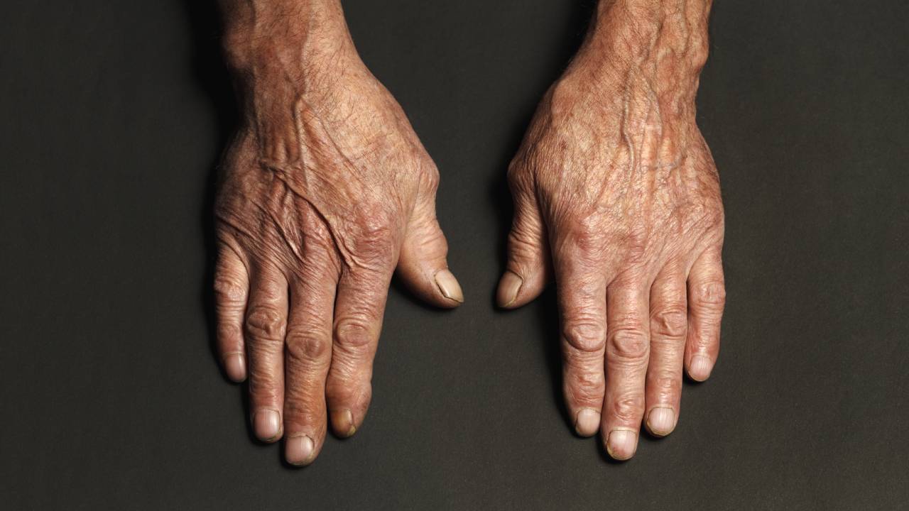 Οι βασικοί τύποι αρθρίτιδας