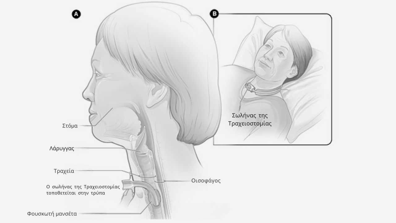 Τι είναι Τραχειοστομία | Doctor Home Care