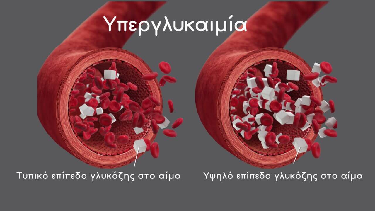 υψηλό επίπεδο γλυκόζης στο αίμα